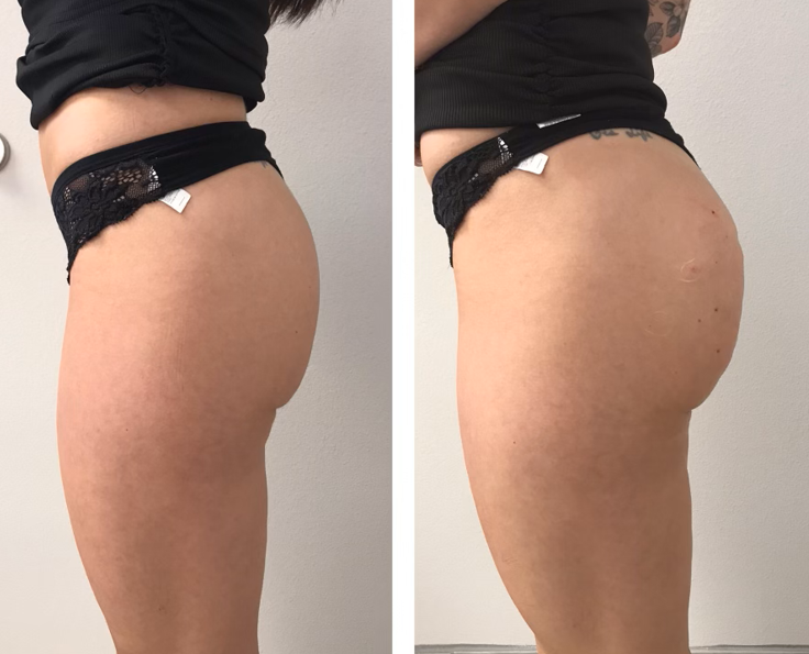 liquid non surgical bbl