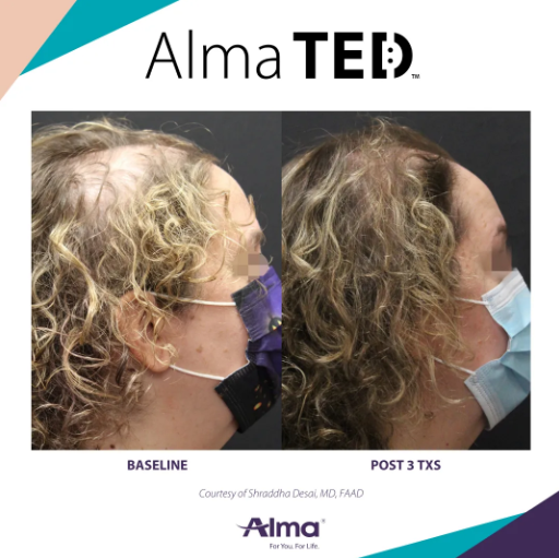 Alma TED by Nurse Holly